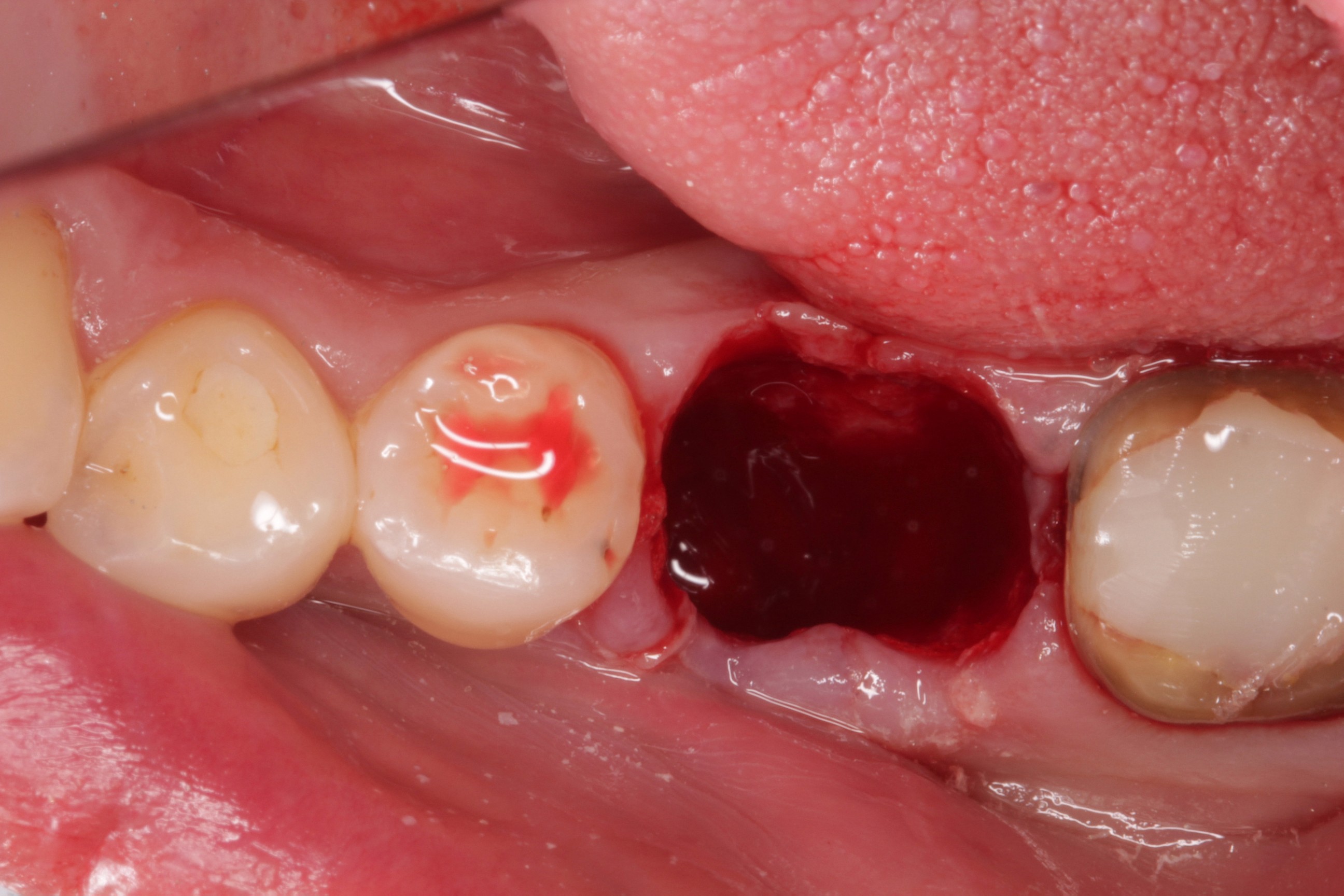 自家歯牙移植の症例 | 市ヶ谷・歯医者