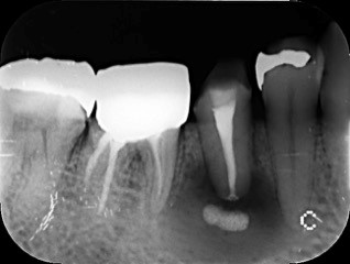 根管治療の症例 | 市ヶ谷・歯医者