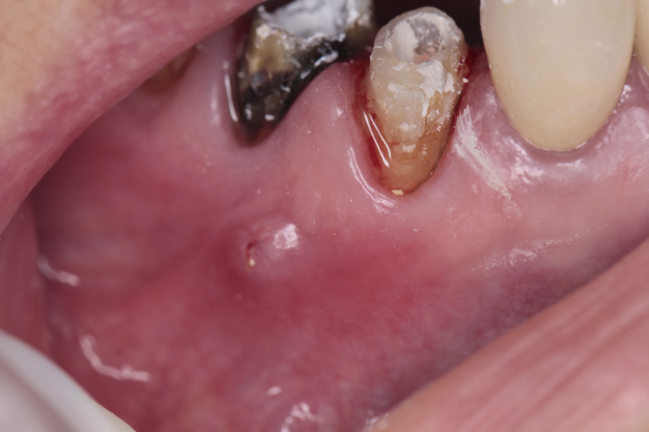 根管治療の症例 | 市ヶ谷・歯医者