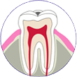 初期の虫歯 | 市ヶ谷・歯医者