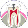 軽度の虫歯 | 市ヶ谷・歯医者