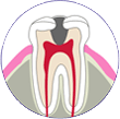 中度の虫歯 | 市ヶ谷・歯医者