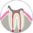 重度の虫歯 | 市ヶ谷・歯医者