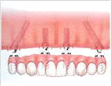 オールオンフォー（無歯顎即日インプラント治療） | 市ヶ谷・歯医者