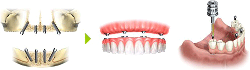 総義歯（総入れ歯）に変わる最新のインプラント治療 | 市ヶ谷・歯医者
