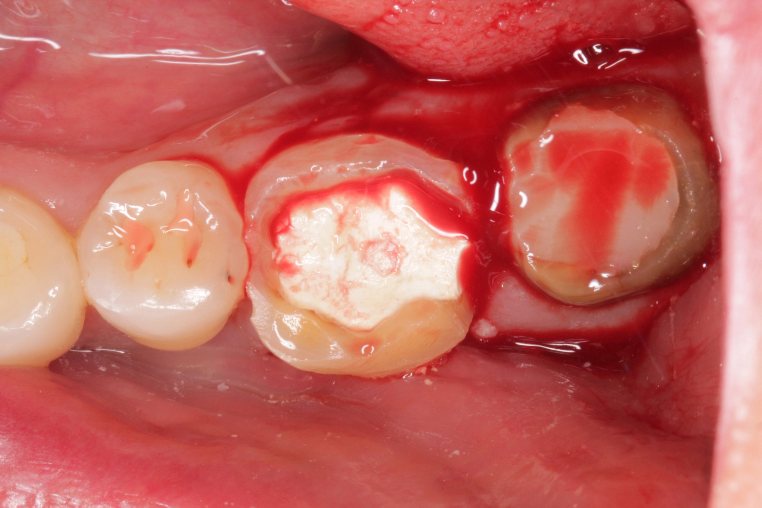 自家歯牙移植の症例 | 市ヶ谷・歯医者