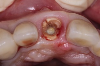インプラントの症例 | 市ヶ谷・歯医者