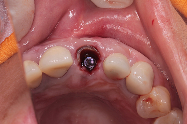 歯根破折による炎症の症例 | 市ヶ谷・歯医者