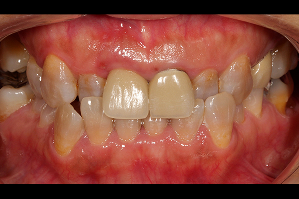 審美歯科の症例 | 市ヶ谷・歯医者