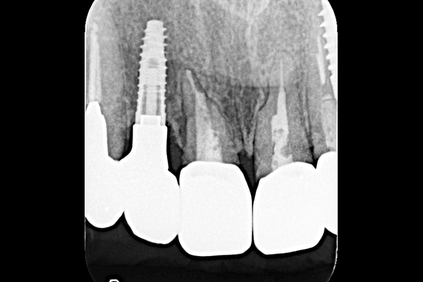 歯根破折による炎症の症例 | 市ヶ谷・歯医者