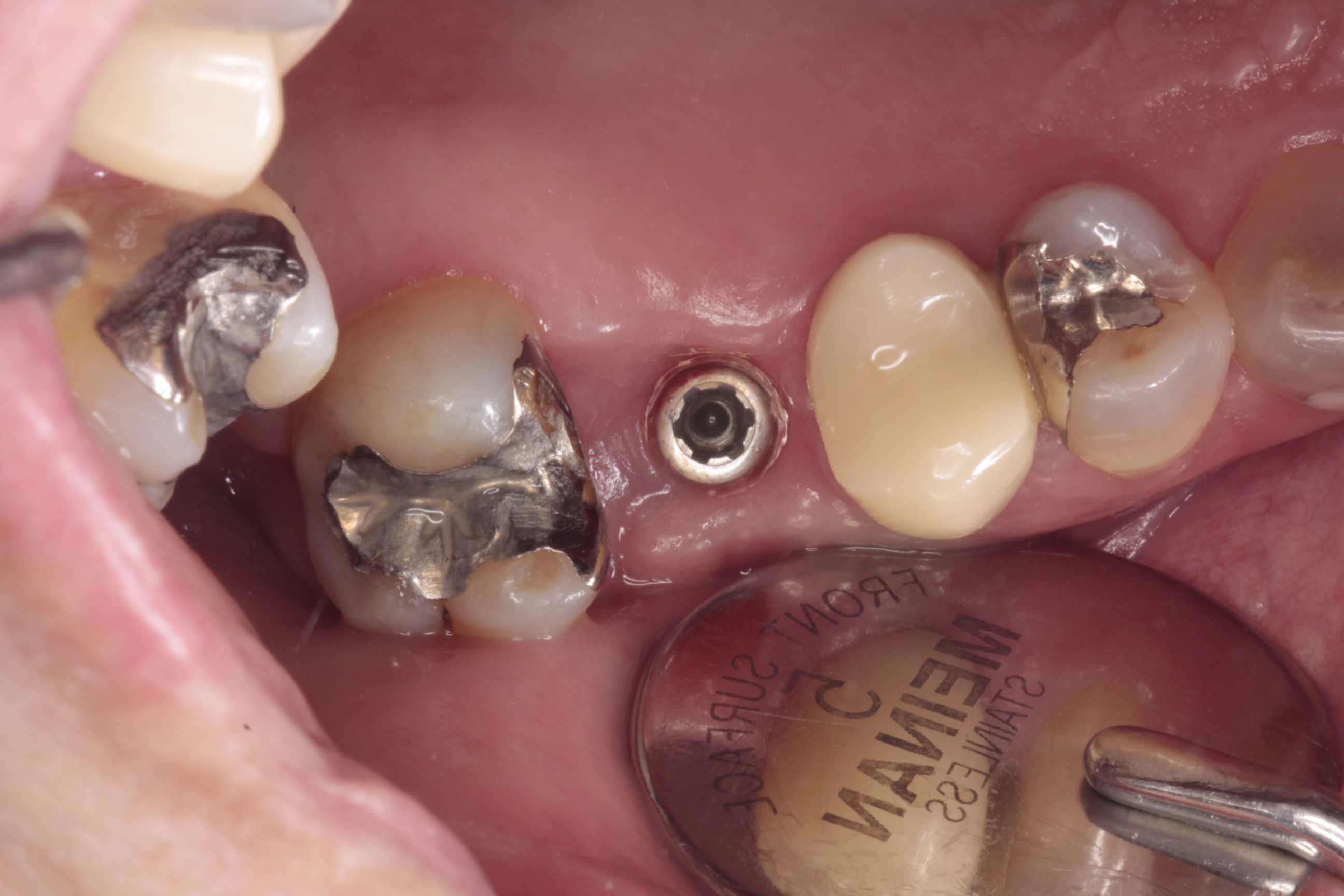 歯の歯折による抜歯の症例 | 市ヶ谷・歯医者