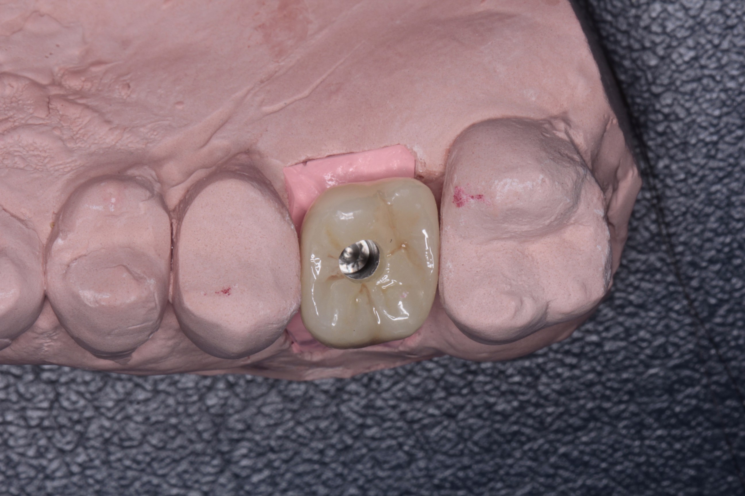 歯の歯折による抜歯の症例 | 市ヶ谷・歯医者