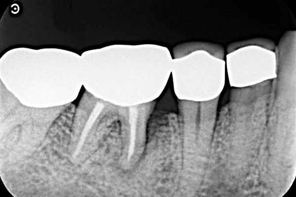 右第一大臼歯の骨欠損の症例 | 市ヶ谷・歯医者