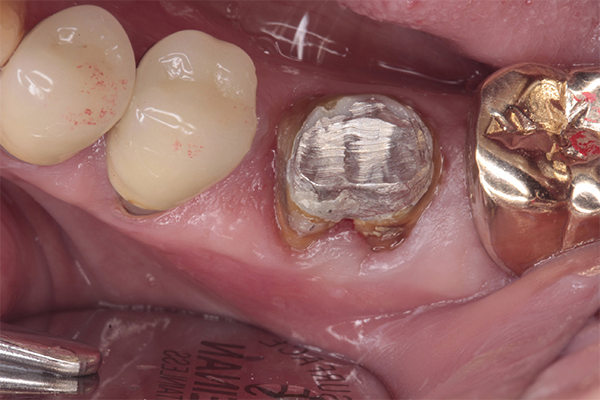 右第一大臼歯の骨欠損の症例 | 市ヶ谷・歯医者