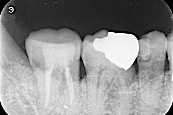 歯槽膿漏と咬合による骨欠損の症例 | 市ヶ谷・歯医者