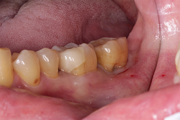 歯槽膿漏と咬合による骨欠損の症例 | 市ヶ谷・歯医者