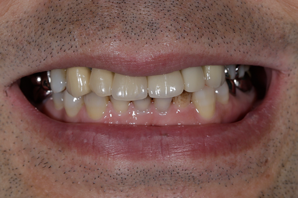 57歳男性インプラントの症例 | 市ヶ谷・歯医者