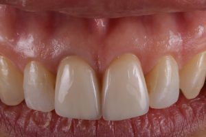 30代女性前歯のセラミック治療 | 市ヶ谷・歯医者