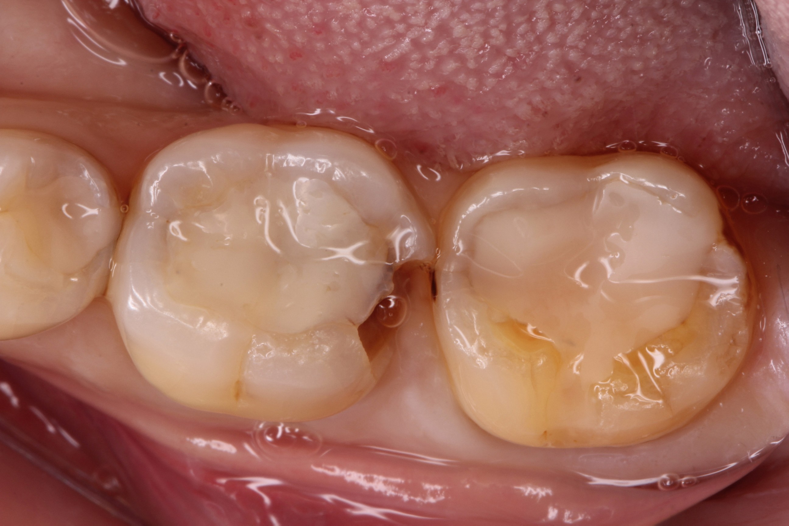 20代女性　奥歯のプラスティックをセラミックで修復した症例 | 市ヶ谷・歯医者
