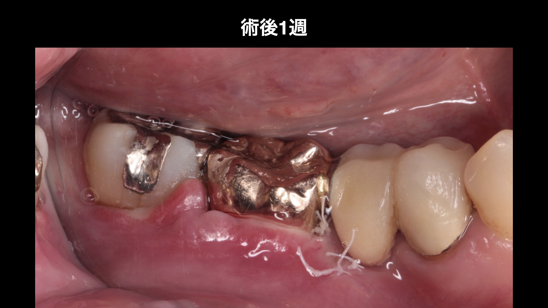 【50代女性】歯肉が腫れる状況を改善し骨、歯肉を再生させたケース | 市ヶ谷・歯医者