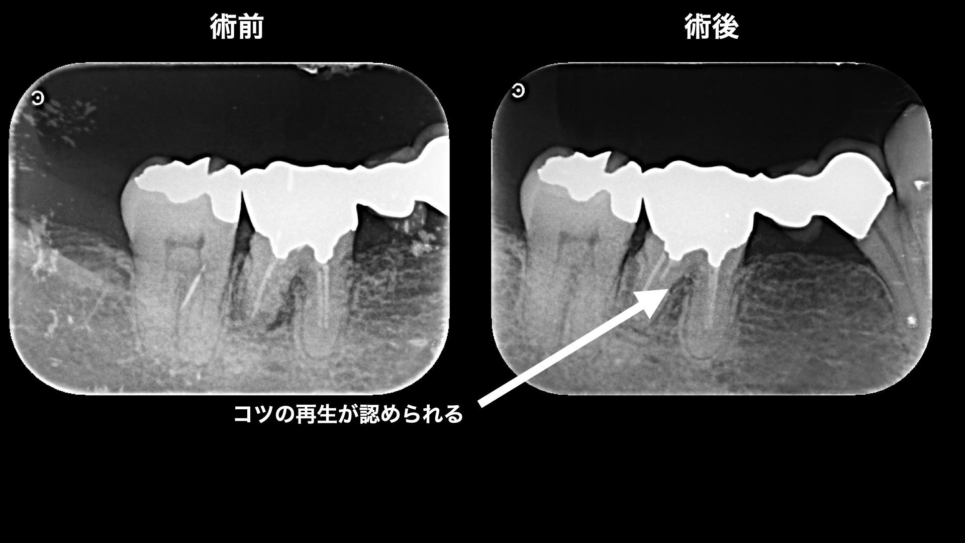 【50代女性】歯肉が腫れる状況を改善し骨、歯肉を再生させたケース | 市ヶ谷・歯医者