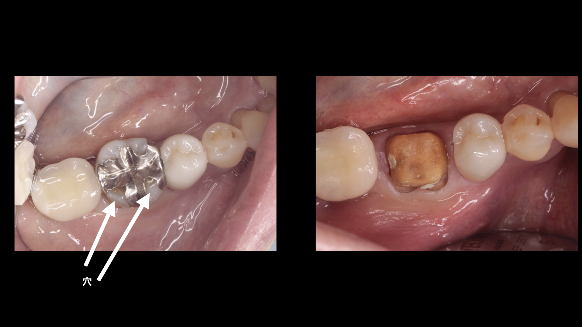 50代女性 銀歯の下の虫歯を除去しセラミックで修復したケース 市ヶ谷の歯医者 海谷歯科医院