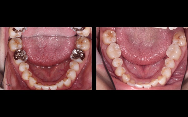 30代女性銀歯の下の虫歯を除去しセラミックで修復したケース 市ヶ谷の歯医者 海谷歯科医院