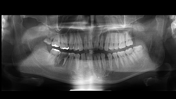 術後2 | 市ヶ谷・歯医者