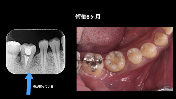 術後1 | 市ヶ谷・歯医者