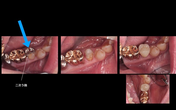 50代女性銀歯の下の虫歯を除去しセラミックで修復したケース 市ヶ谷の歯医者 海谷歯科医院