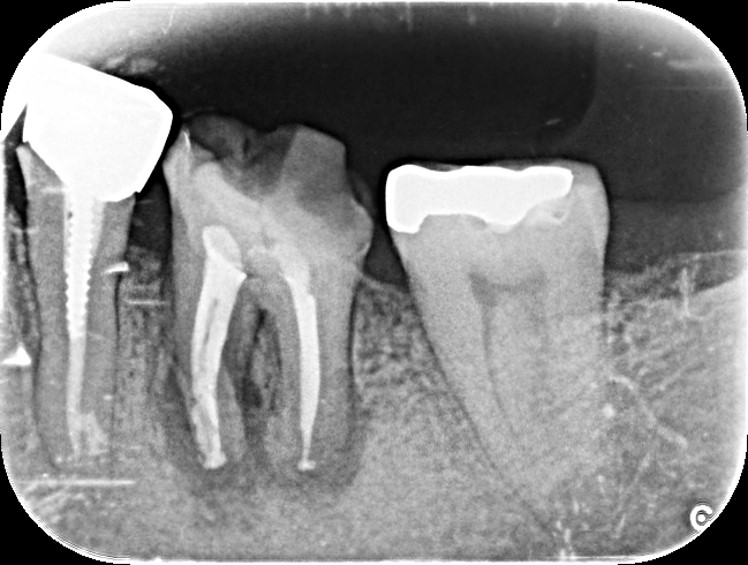 長く歯茎の腫れが引かない歯をMTAによる根管治療で治癒させたケース | 市ヶ谷・歯医者