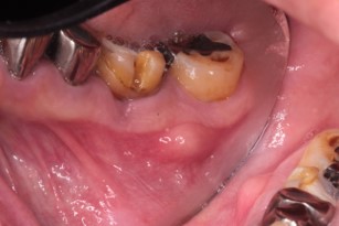 歯茎 の 腫れ