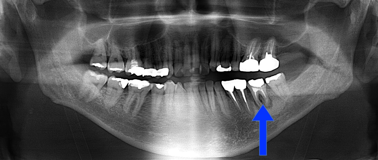 長く歯茎の腫れが引かない歯をMTAによる根管治療で治癒させたケース | 市ヶ谷・歯医者