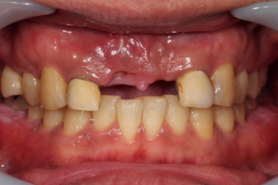 30代男性「前歯が2本ない」「かぶせものが割れた」目立たない入れ歯で治療した症例 | 市ヶ谷・歯医者