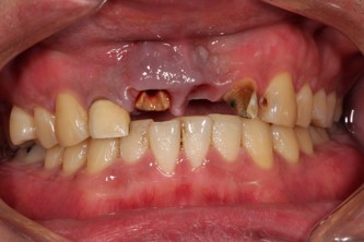 30代男性「前歯が2本ない」「かぶせものが割れた」目立たない入れ歯で治療した症例 | 市ヶ谷・歯医者