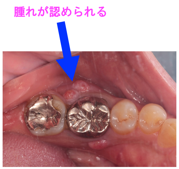 割れた歯を抜歯後インプラントで原状回復した症例 | 市ヶ谷・歯医者
