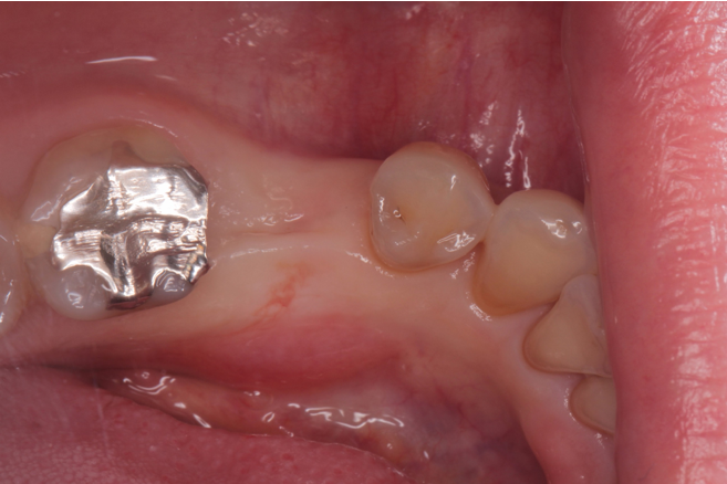 30代女性 乳歯が残存した部位を抜歯しインプラントで機能回復したケース | 市ヶ谷・歯医者
