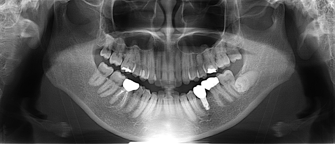 30代女性 乳歯が残存した部位を抜歯しインプラントで機能回復したケース | 市ヶ谷・歯医者