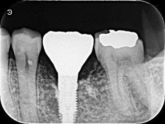 割れた歯を抜歯後インプラントで原状回復した症例 | 市ヶ谷・歯医者