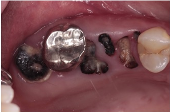 30歳女性 全顎的に噛み合わせが壊れた患者さんにインプラントで噛み合わせを回復させたケース | 市ヶ谷・歯医者