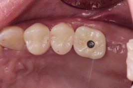 30歳女性 全顎的に噛み合わせが壊れた患者さんにインプラントで噛み合わせを回復させたケース | 市ヶ谷・歯医者