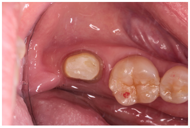50代女性「歯が動く、噛めない」抜歯適応の歯を根管治療により再生させジルコニアで咬合回復させたケース | 市ヶ谷・歯医者