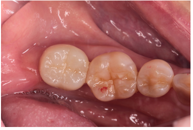 50代女性「歯が動く、噛めない」抜歯適応の歯を根管治療により再生させジルコニアで咬合回復させたケース | 市ヶ谷・歯医者