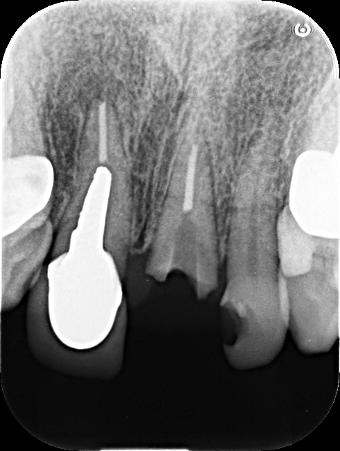 50代女性  折れた前歯をインプラントにより審美回復したケース | 市ヶ谷・歯医者