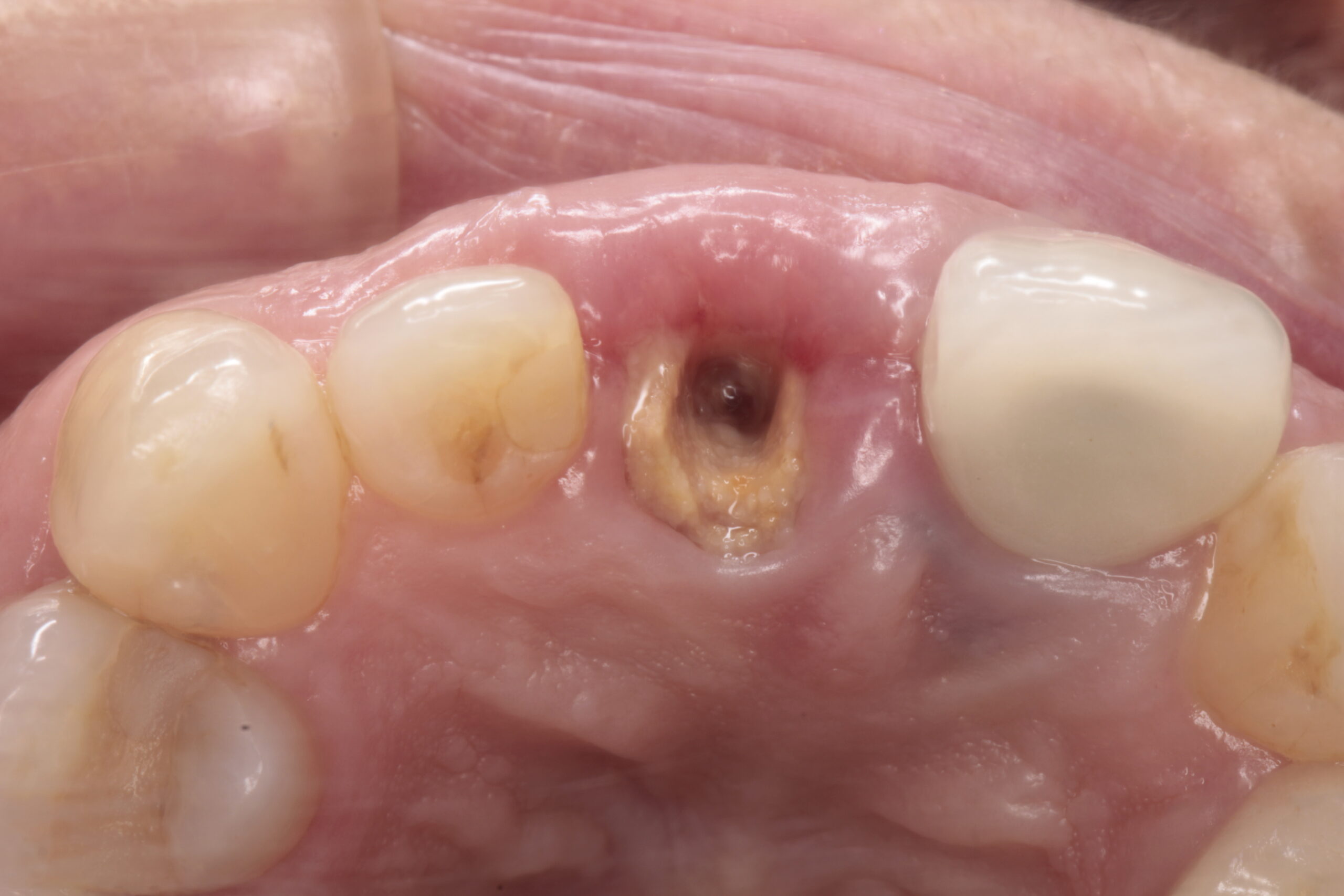50代女性  折れた前歯をインプラントにより審美回復したケース | 市ヶ谷・歯医者