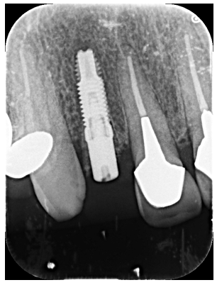 40歳男性「歯が取れて歯肉が腫れてきた」歯根破折した歯を抜歯しインプラントで審美修復したケース | 市ヶ谷・歯医者