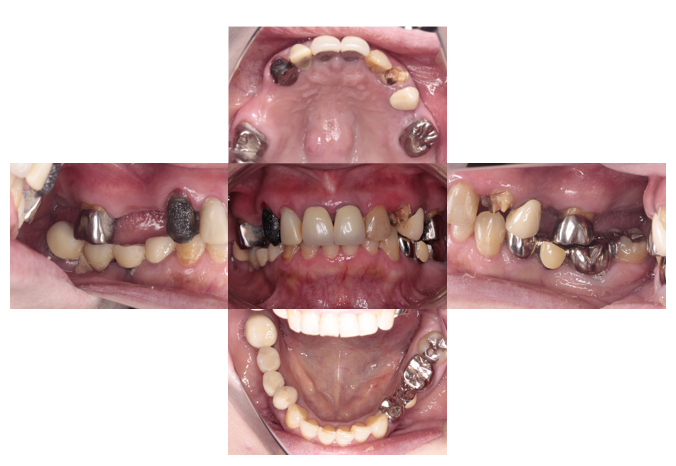 60代女性「歯がボロボロなのできちんと治したい」咬合崩壊した患者をジルコニアで審美回復したケース | 市ヶ谷・歯医者