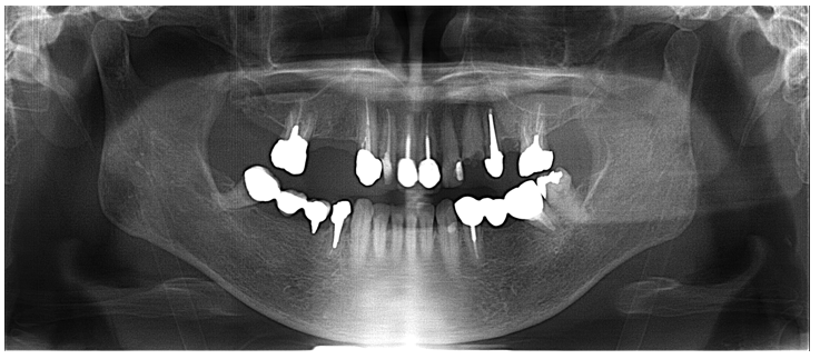 60代女性「歯がボロボロなのできちんと治したい」咬合崩壊した患者をジルコニアで審美回復したケース | 市ヶ谷・歯医者
