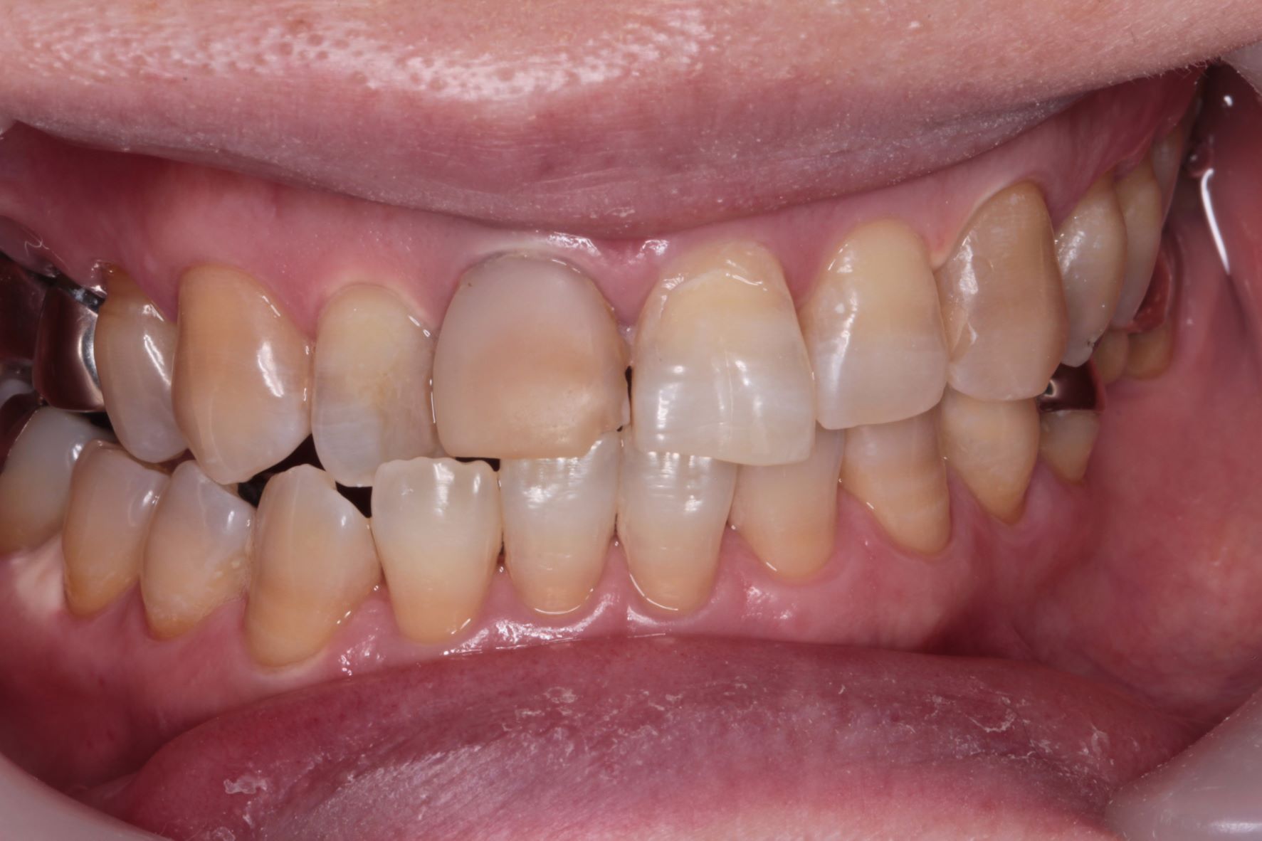 50代女性　かけた前歯をセラミックで審美修復したケース | 市ヶ谷・歯医者