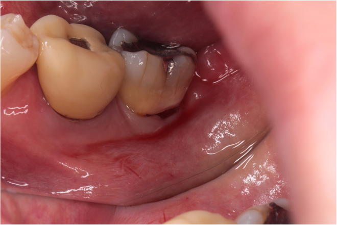 53歳女性「噛むと痛い」「歯がしみる」歯髄炎になった歯を根管治療しセラミッククラウンで機能回復したケース | 市ヶ谷・歯医者